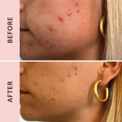 Pudderdåserne Azelainsyre 10% 50 Ml -Clarins Butik pudderdaserne azelain acid 10 50 ml 1670246519