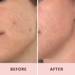 Pudderdåserne Azelainsyre 10% 50 Ml -Clarins Butik pudderdaserne azelain acid 10 50 ml 1670246536